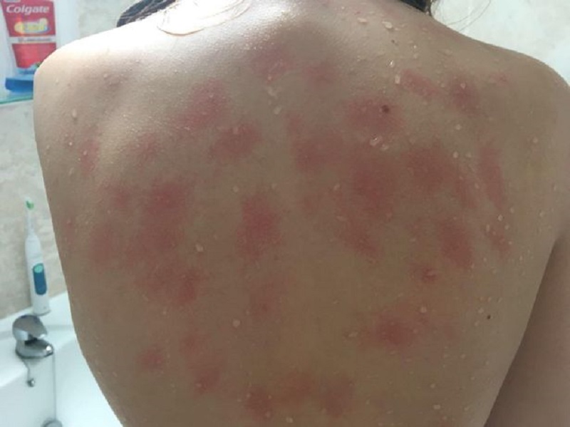 alergię