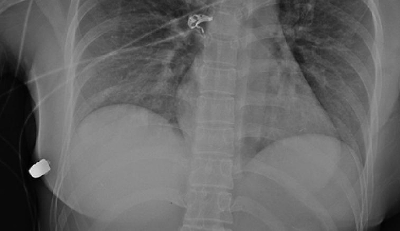 силиконовая грудь на рентгене фото 3